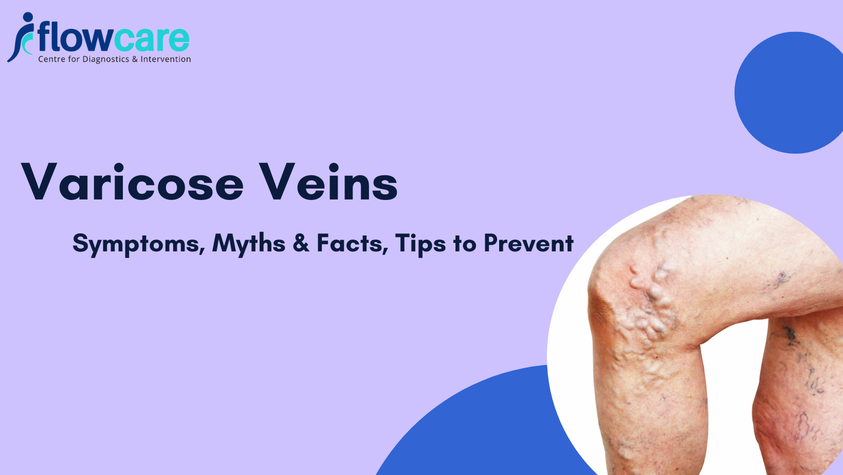 signs of varicose veins