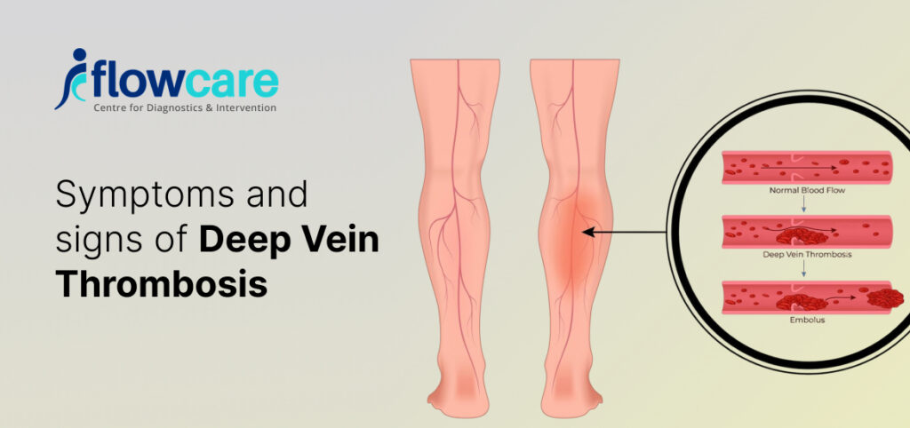 Deep Vein Thrombosis