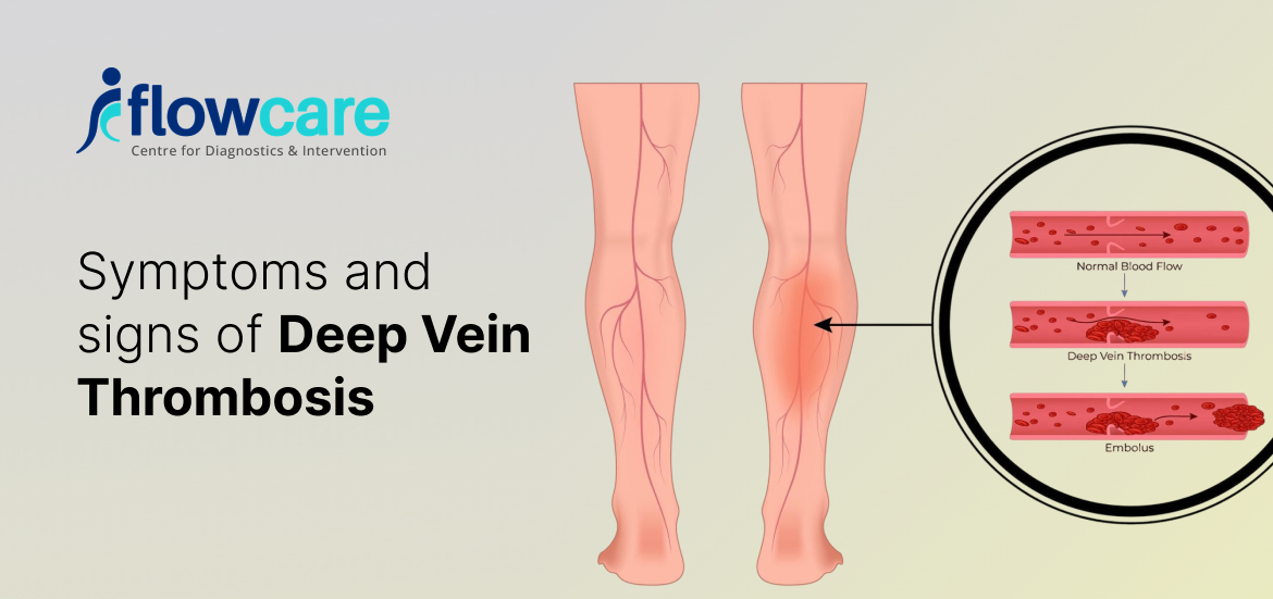 Deep Vein Thrombosis