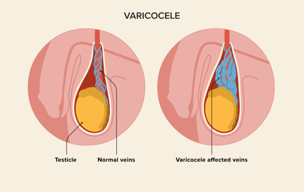 Scrotal Swelling