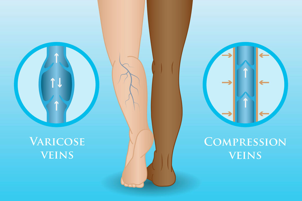 compression-socks-image