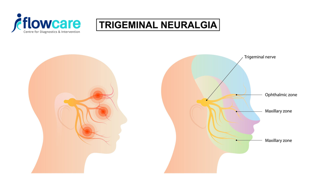 Facial Pain