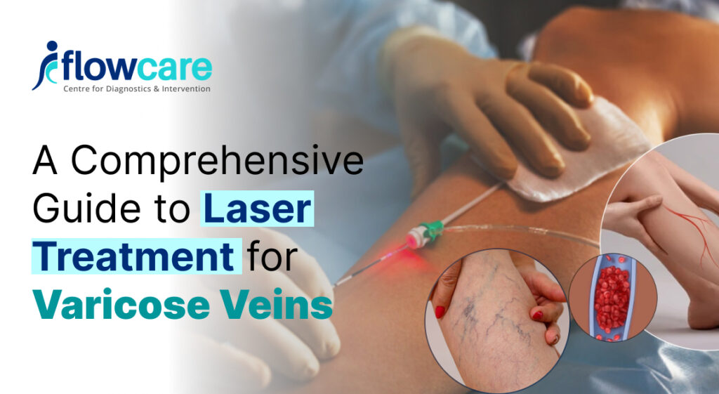 Laser Treatment for Varicose Veins