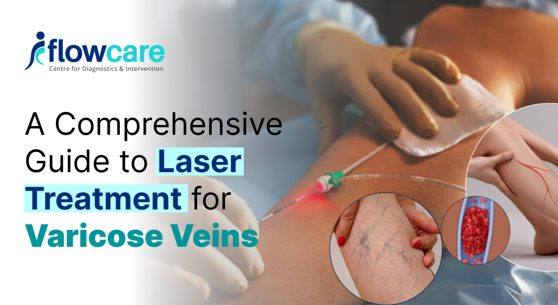 Laser Treatment for Varicose Veins