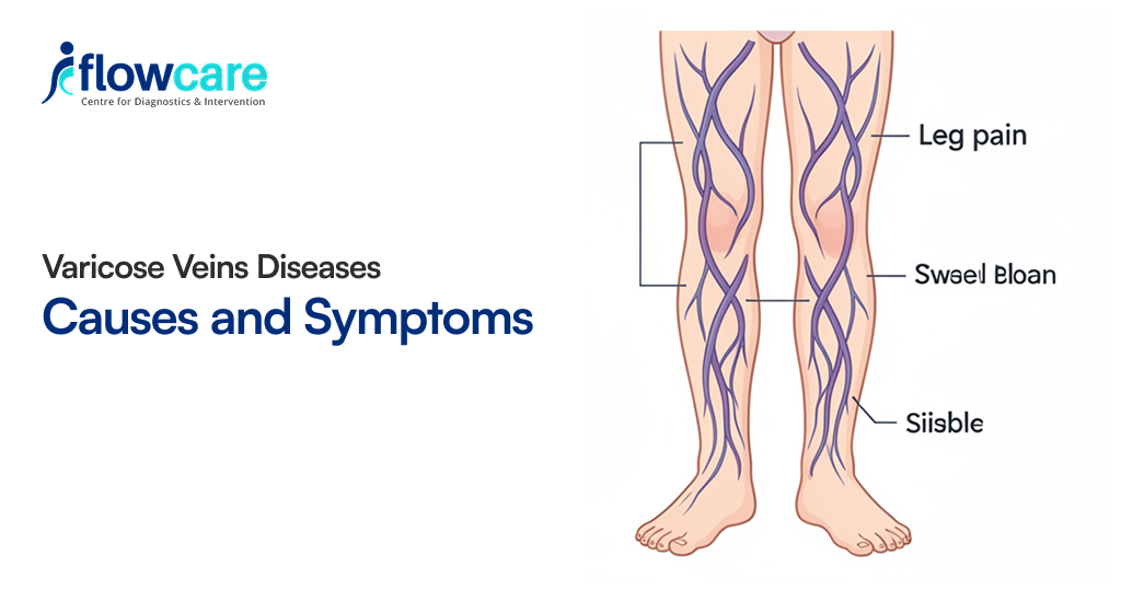 Varicose Veins Diseases