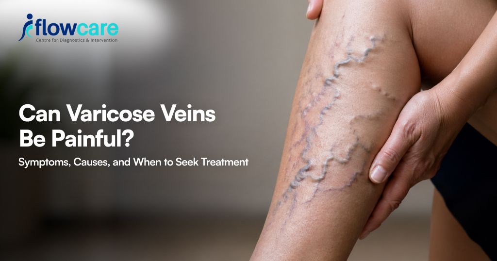 Can Varicose Veins Be Painful